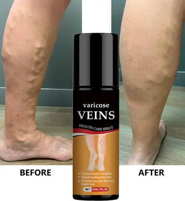 Varicose Veins Relief Cream – Natural Herbal Formula for Smooth, Healthy Legs